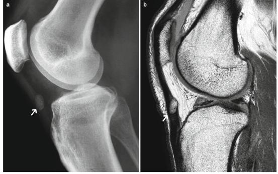 髕腱炎成為醫(yī)學(xué)焦點(diǎn)，從幕后走向舞臺(tái)中央的最新進(jìn)展