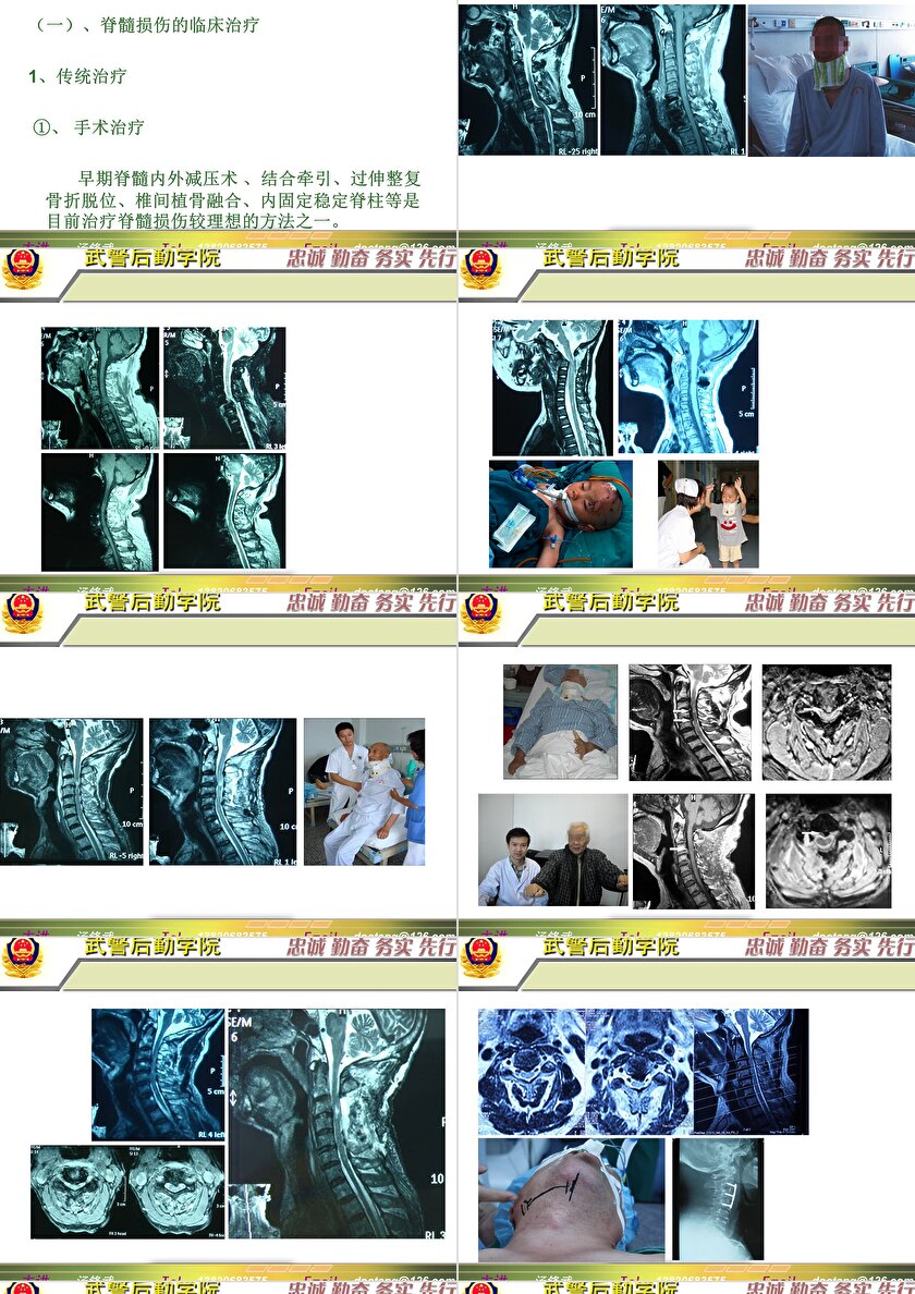 2023年脊髓損傷研究新進(jìn)展，里程碑式的突破與日常奇妙變化