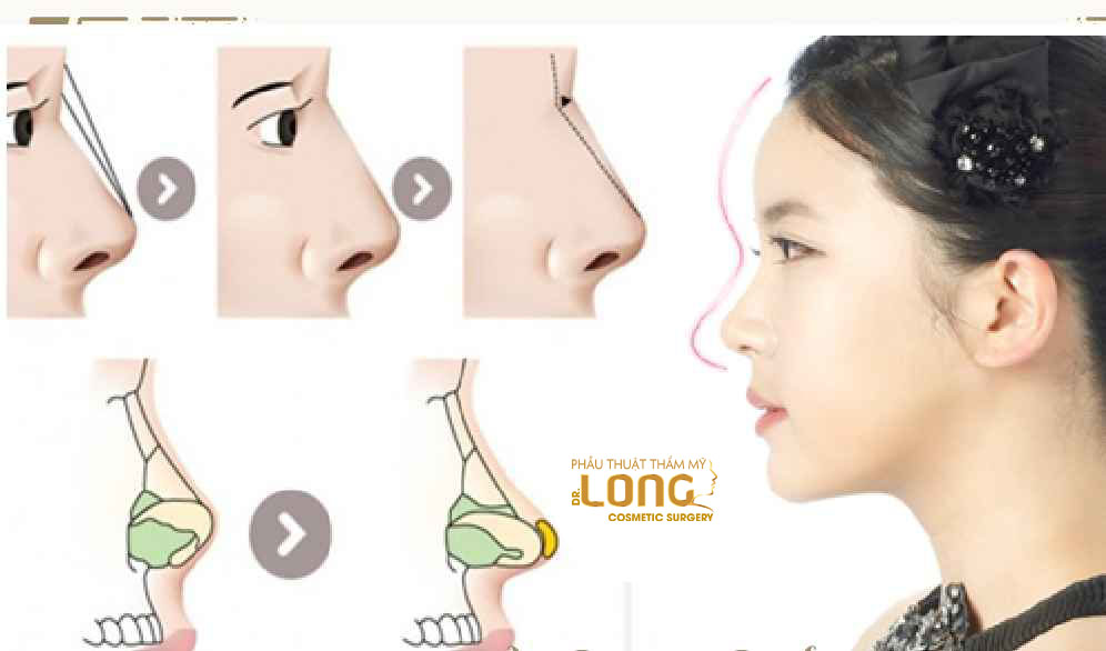 最新鼻整形技術重塑自信，煥發(fā)新生之美