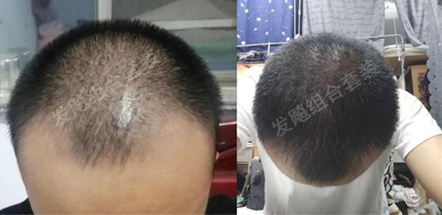 治愈脫發(fā)最新重大突破，重塑自信，希望之光再現(xiàn)