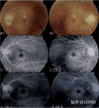 最新藥肺炎詳解，你需要知道的一切——健康小紅書