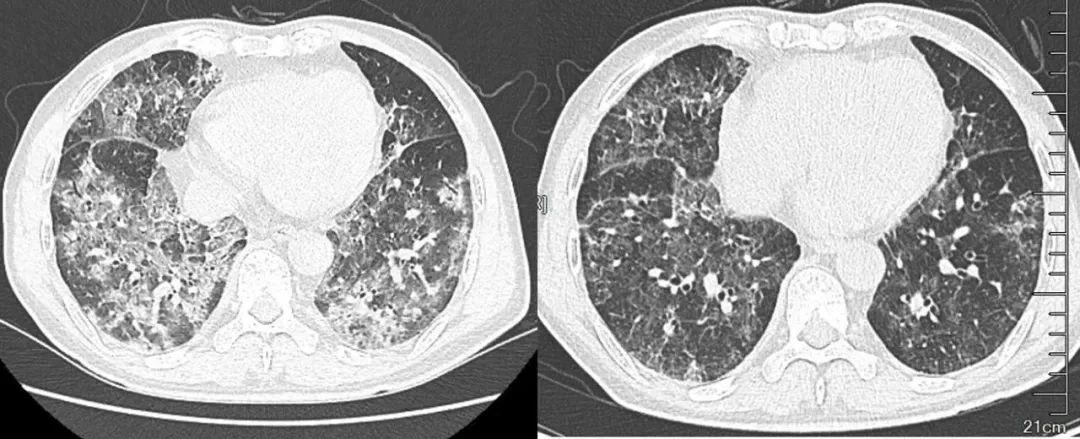 科技前沿高科技產(chǎn)品助力新冠心肺炎抗疫之路最新進(jìn)展